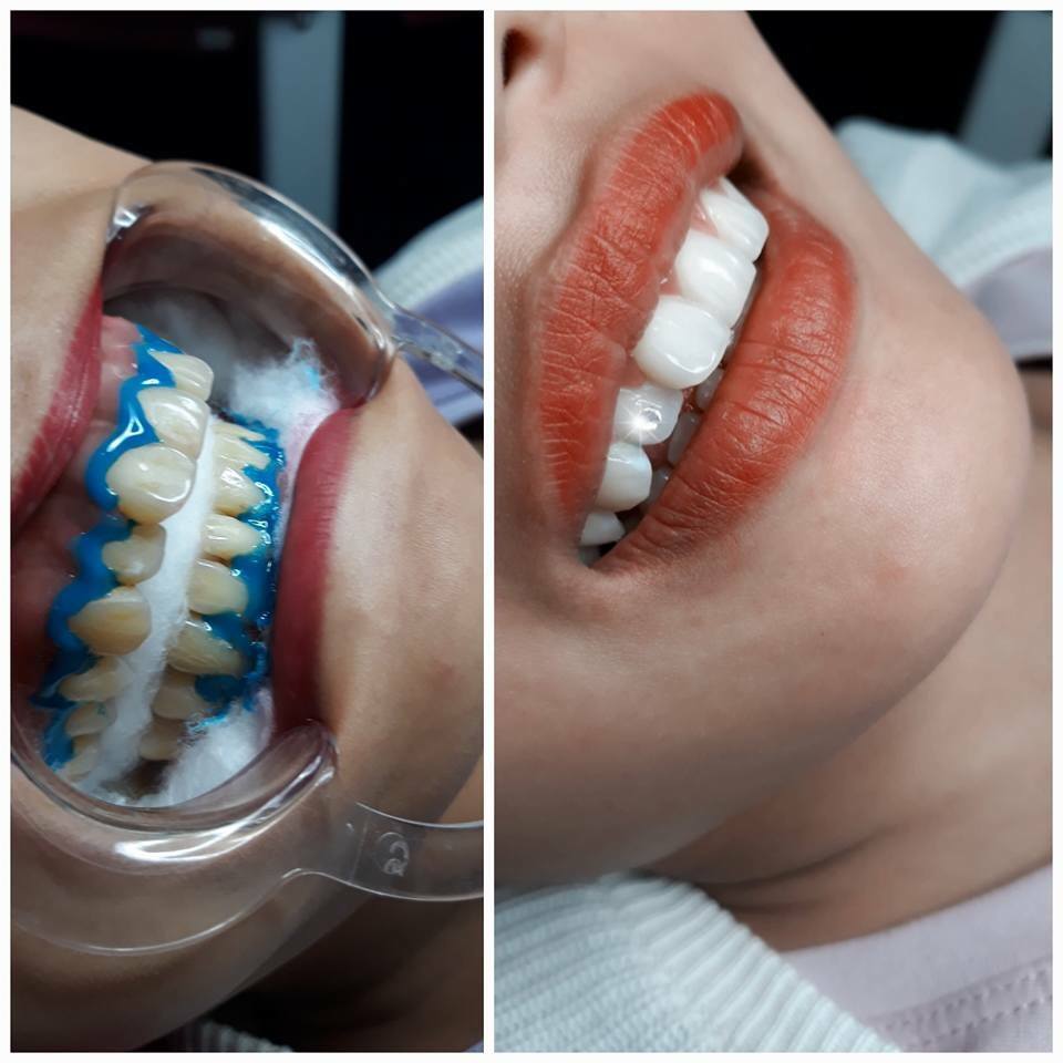 thuốc tẩy trắng răng pha sẵn (bật tông sau 30p)