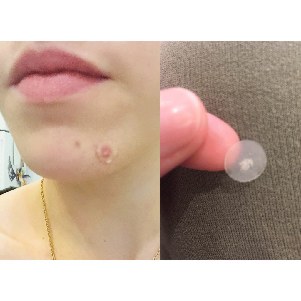 Miếng dán mụn Mayancare hồng
