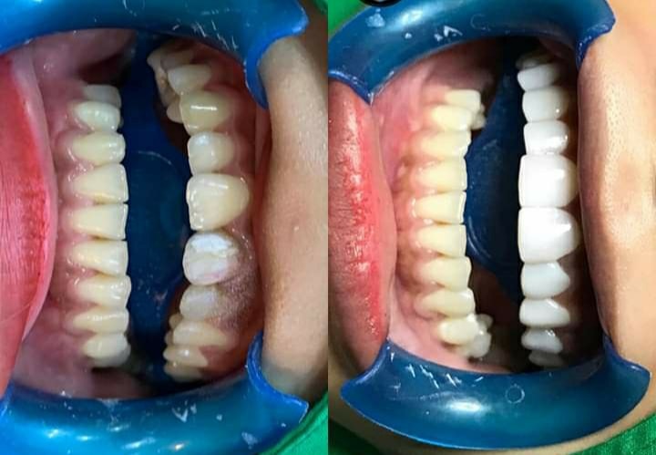 thuốc tẩy trắng răng philipin (bật tông cực trắng. không gây ê buốt)
