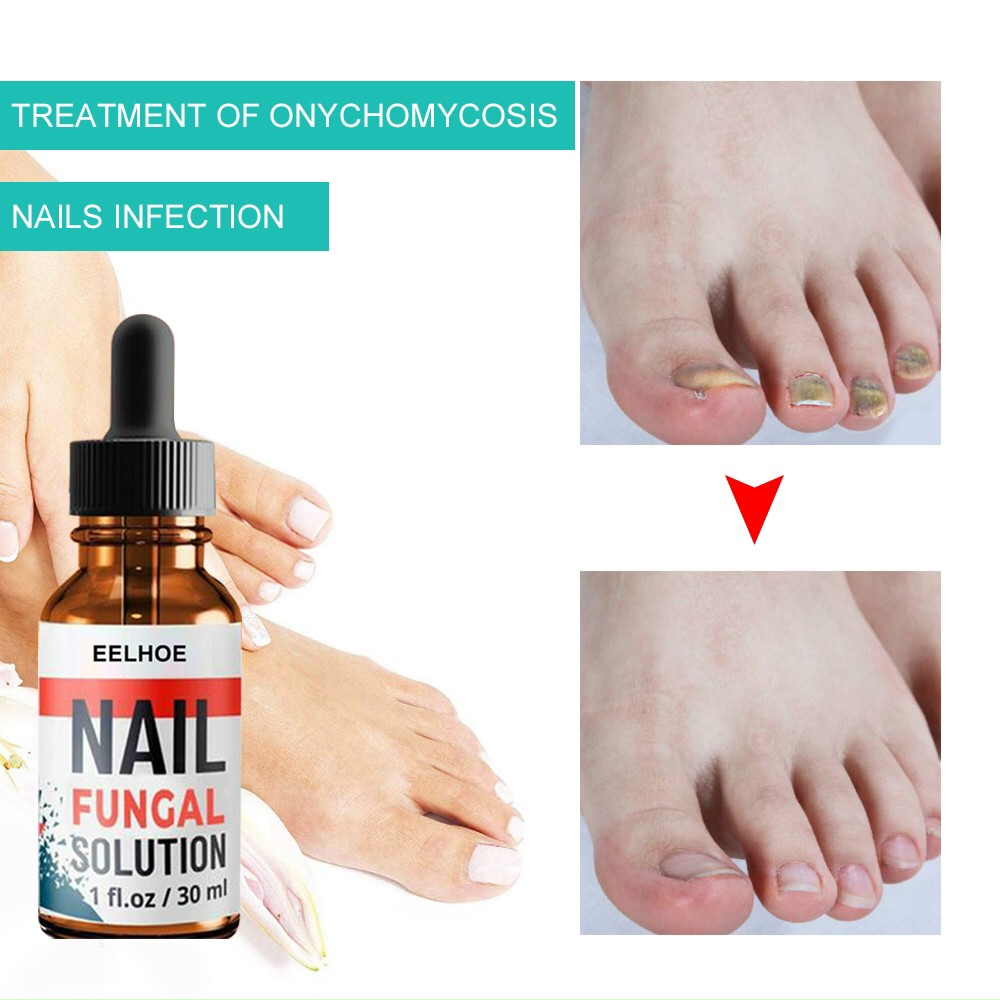 Serum trị nấm móng dưỡng móng phục hồi móng hư tổn