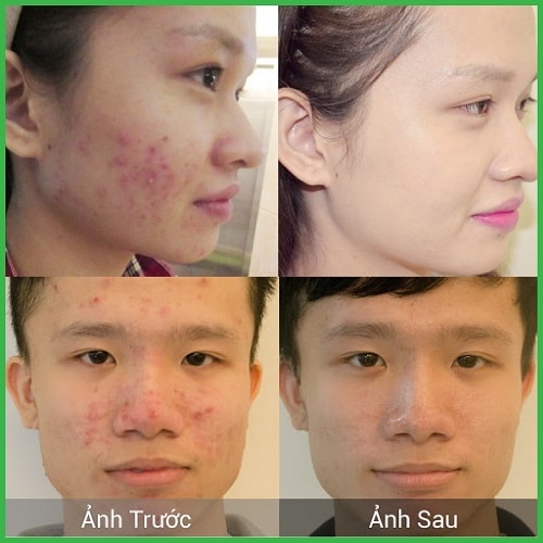 [COMBO 2 LỌ] Dung dịch chấm mụn bí đao cocoon vietnam 5ml