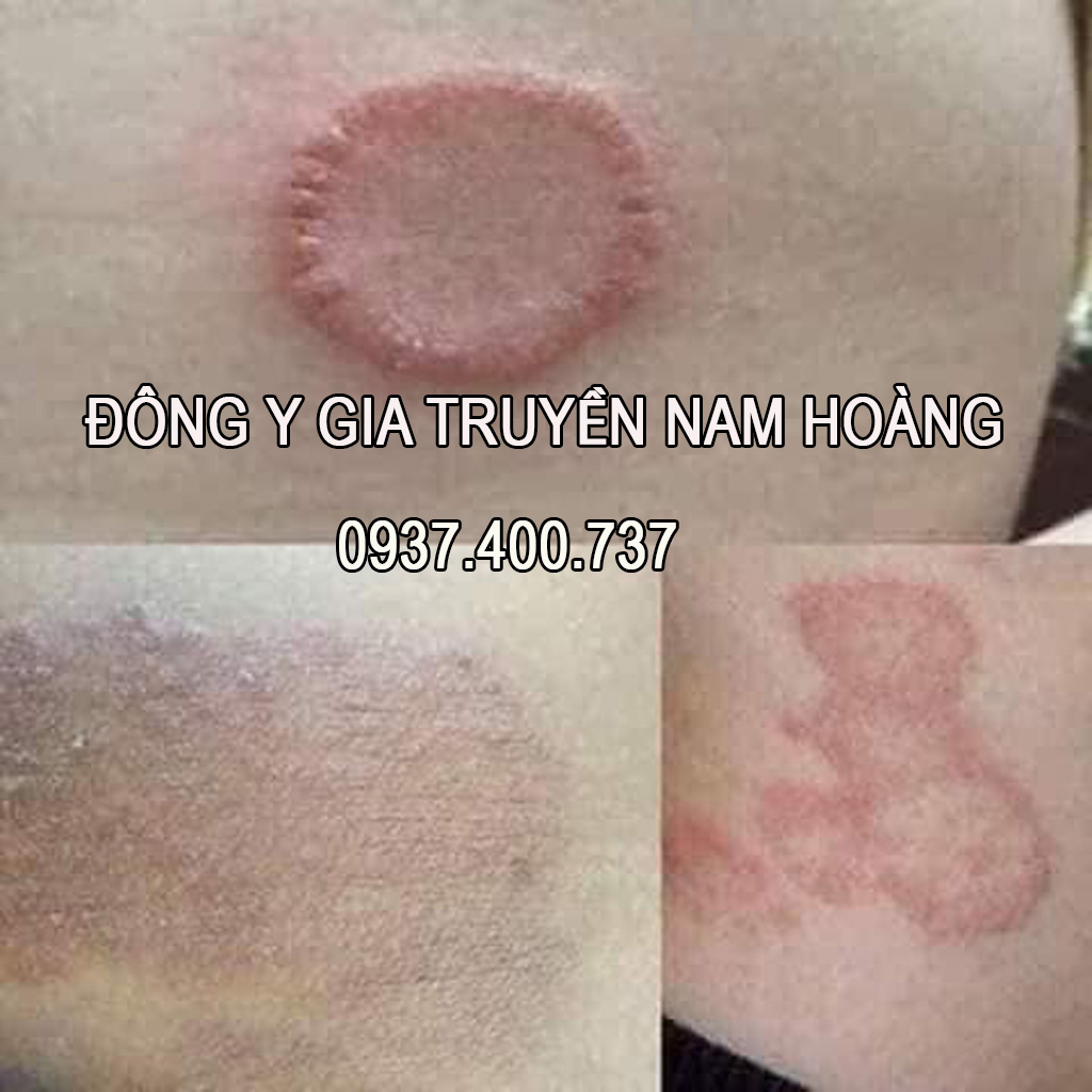 Thuoc Tri Benh Hac Lao Nam Hoang