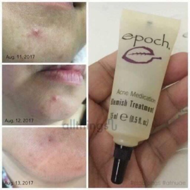 [HCM]Tý chấm Mụn Epoch của Nuskin