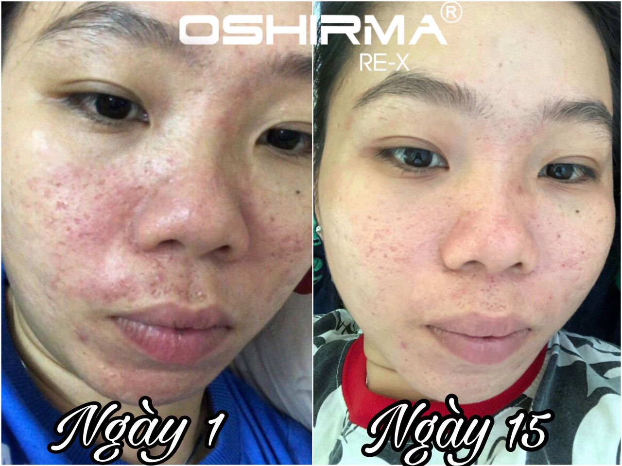 Bộ Phục Hồi Da Yếu Nhạy Cảm Oshirma