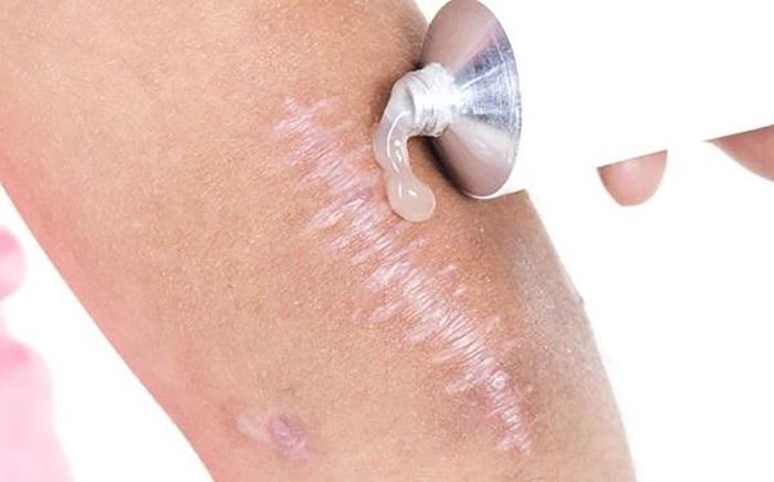 kem mờ sẹo,rạng da nga Klirvin 25g