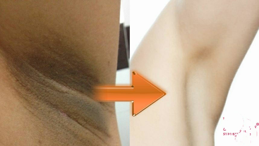 [HCM]Kem Dưỡng Trắng Nách Xóa Thâm Mịn Da DIDIE
