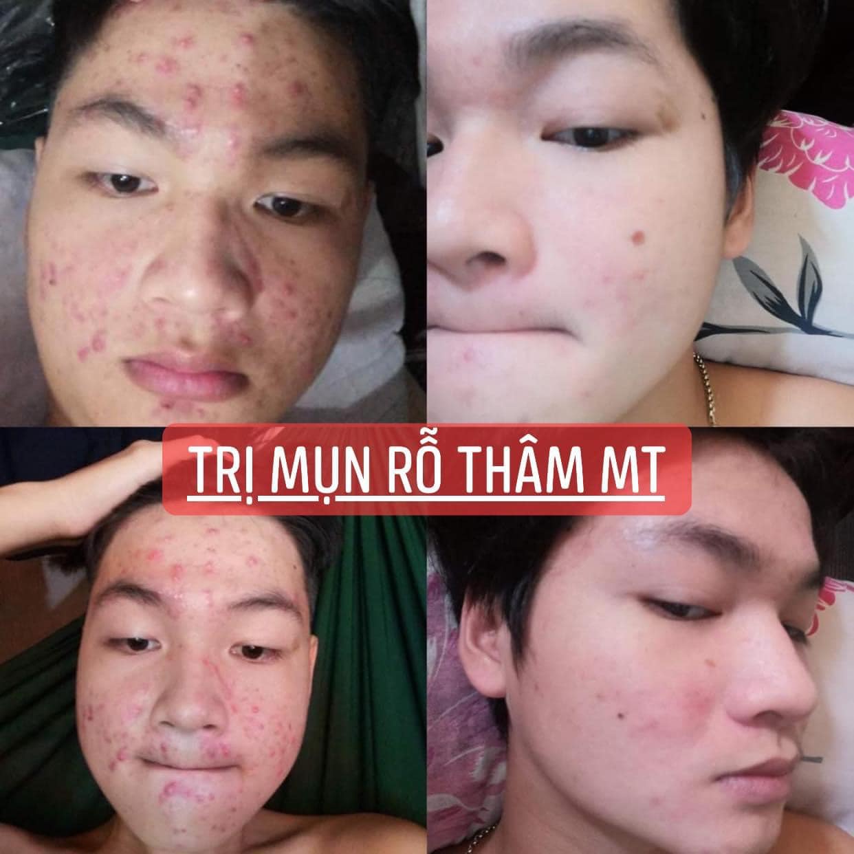 Compo 2 Lọ Tái Tạo Da (50ml)