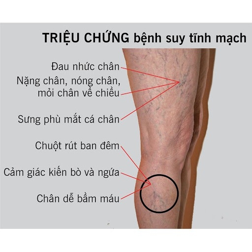 Kem Suy Giãn Tĩnh Mạch PHILOSOFT Thái Lan