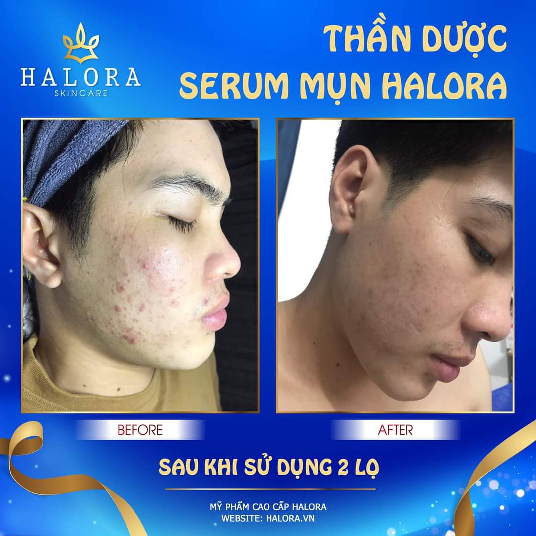[HCM]Serum Mụn Halora