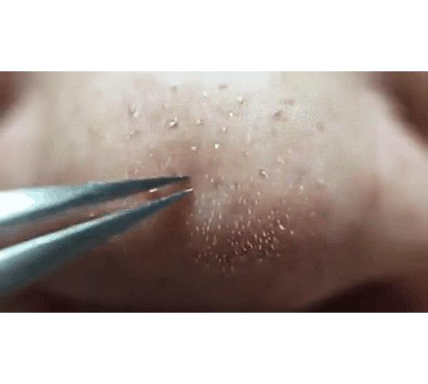 [HCM][Giá hủy diệt] Nhíp lấy mụn chiều dài 8.7 cm
