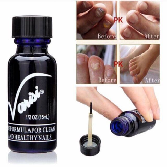 Varisi loại bỏ nấm móng tay, nấm móng chân