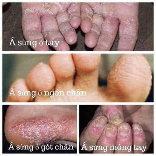 RẠN NỨT DA, VIÊM NANG LÔNG TKH ( cty Trần Kim Huyền)