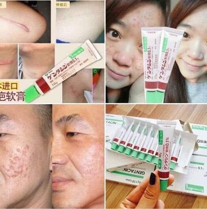 [HCM]Gel Làm Mờ Sẹo MSD Gentacin Ointment 0.1- Gentamicin Sulfate - 10g