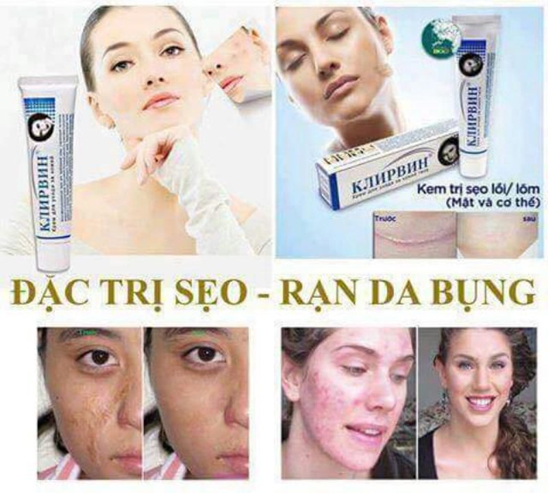 Kem mờ sẹo Klirvin Nga