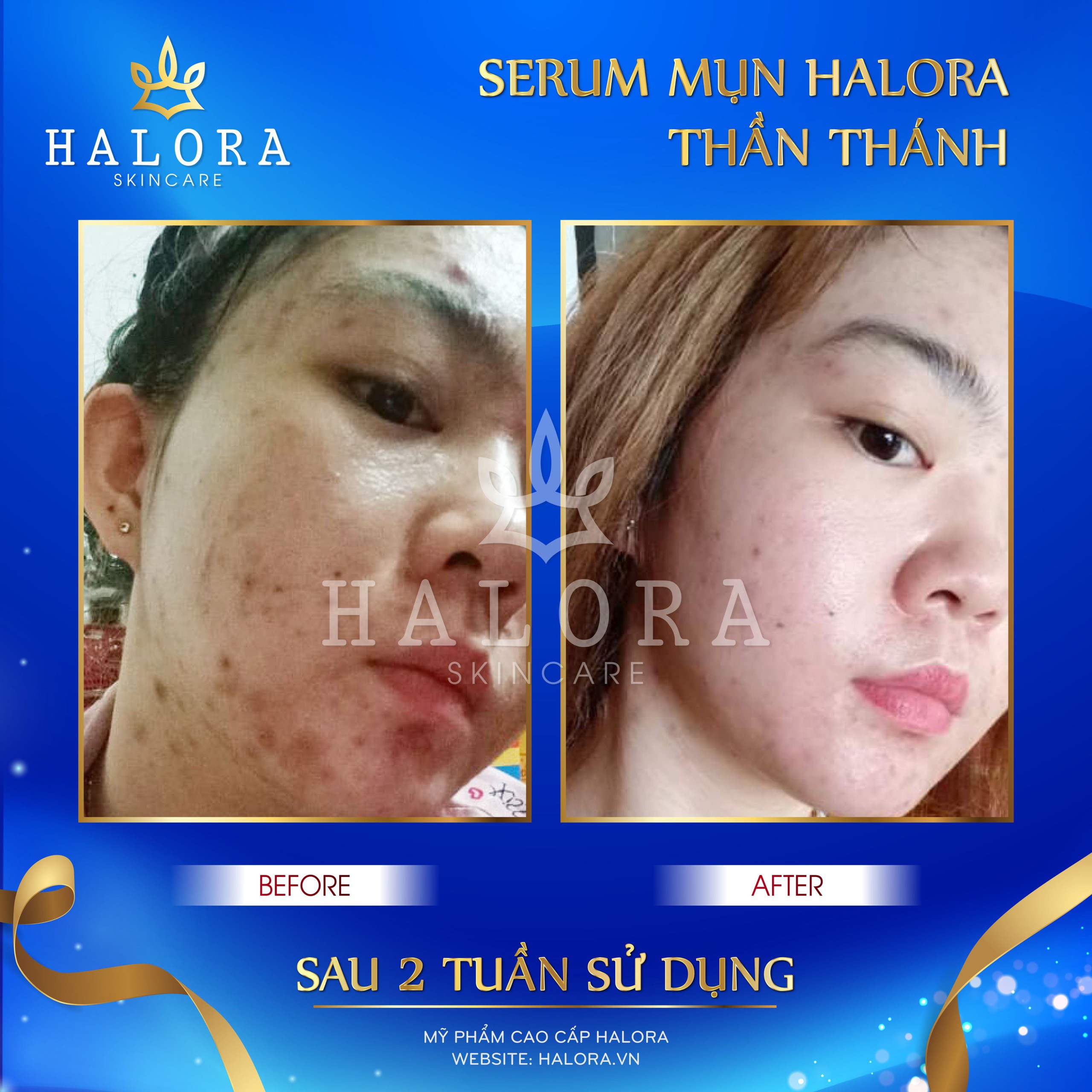 [HCM]Serum Mụn Halora