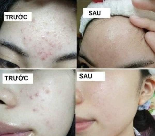 Gel TRỊ Mụn Trứng Cá Megaduo 15g