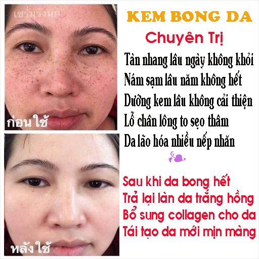 [HCM]Kem Bong Trắng Da BEZY Mờ Nám Thâm Sạm Tàn Nhang