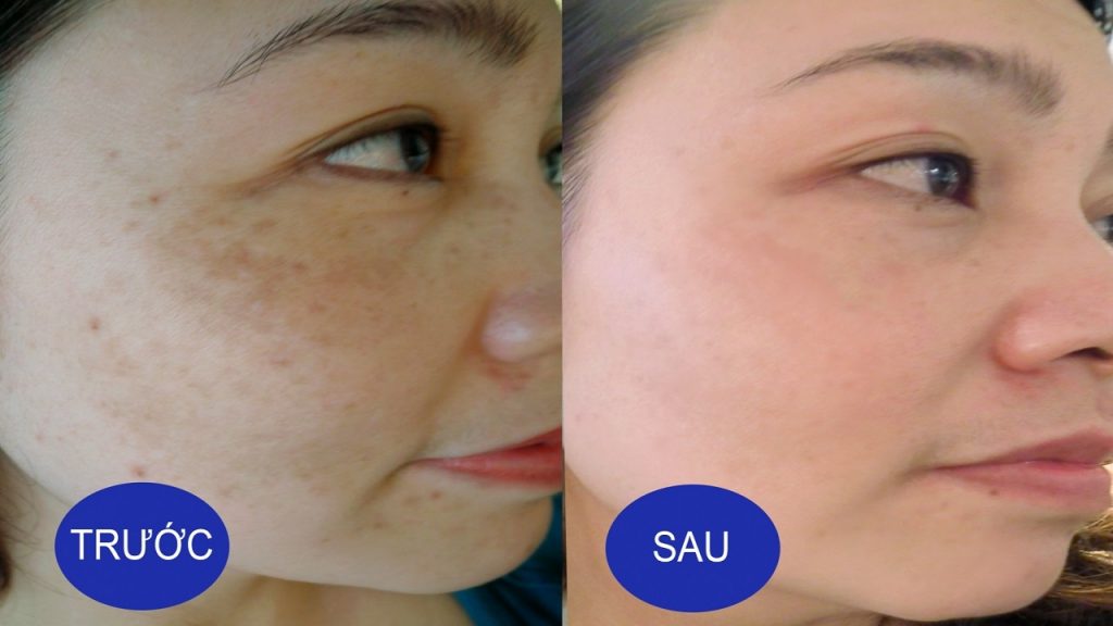 Serum Trắng Da Xóa Thâm Mờ Nám - Hispa Cloud Serum