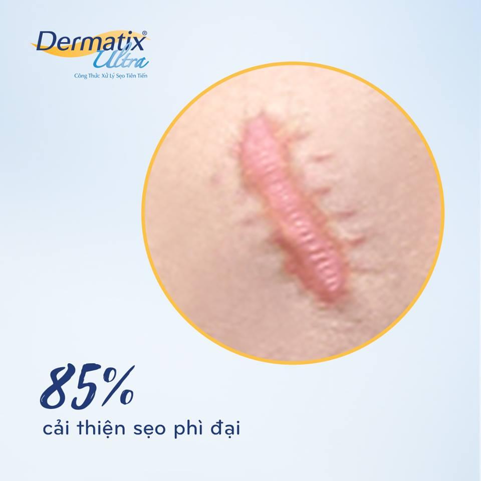 [GIẢM 20K ĐƠN 399K] Dermatix Ultra Gel Làm Mờ Sẹo 7g