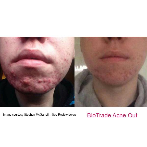 [HÀNG CÔNG TY] Chấm Mụn Biotrade Acne Out Active Lotion