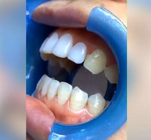 đèn chiếu phủ bóng răng biox..phủ trám răng sứ xinh học