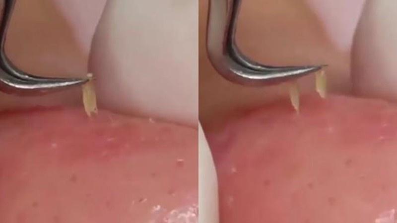 [HCM]Combo 2 Nhíp Gắp Mụn Đầu Đen Mụn Dưới Da Thông Minh