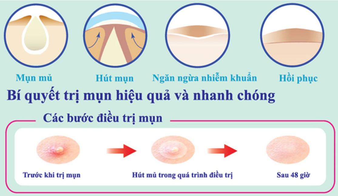 Miếng dán mụn cấp tốc Hàn Quốc, Mayan Care Ultra thin spot