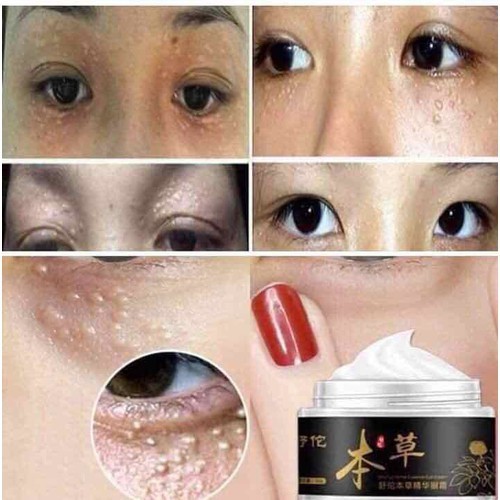 Kem sáng vùng mắt dẹp mụn thịt quanh mắt