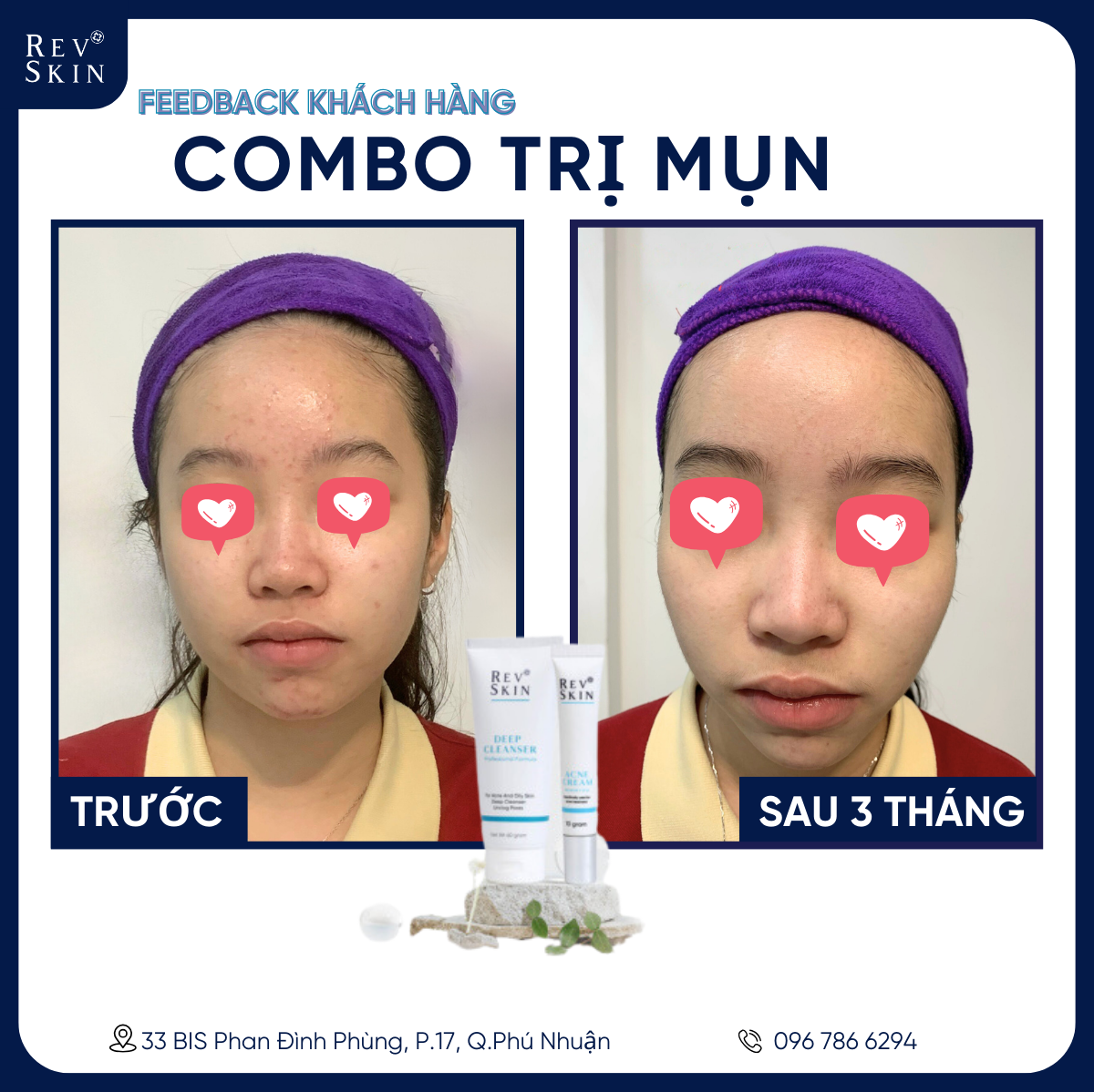 Sữa Rửa Mặt RevSkin Deep Cleanser Cho Da Dầu - Mụn - 60g