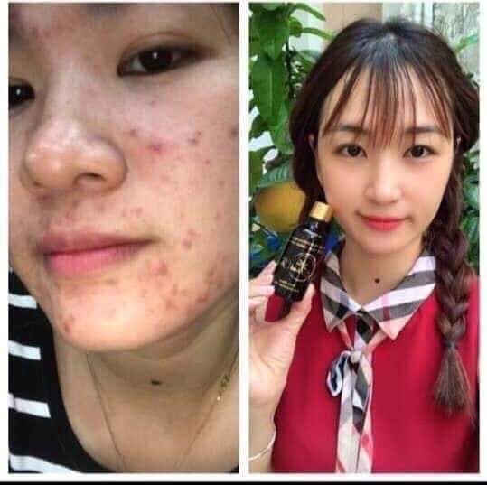 Linh chi vi mụn