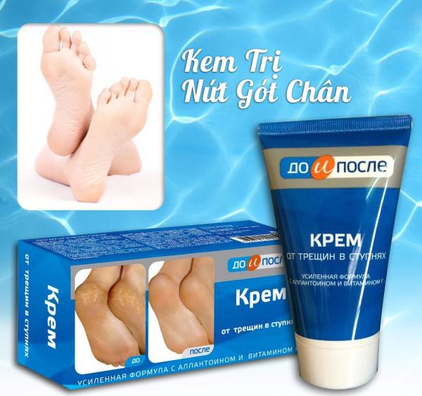 Kem nứt gót chân Kpem Nga