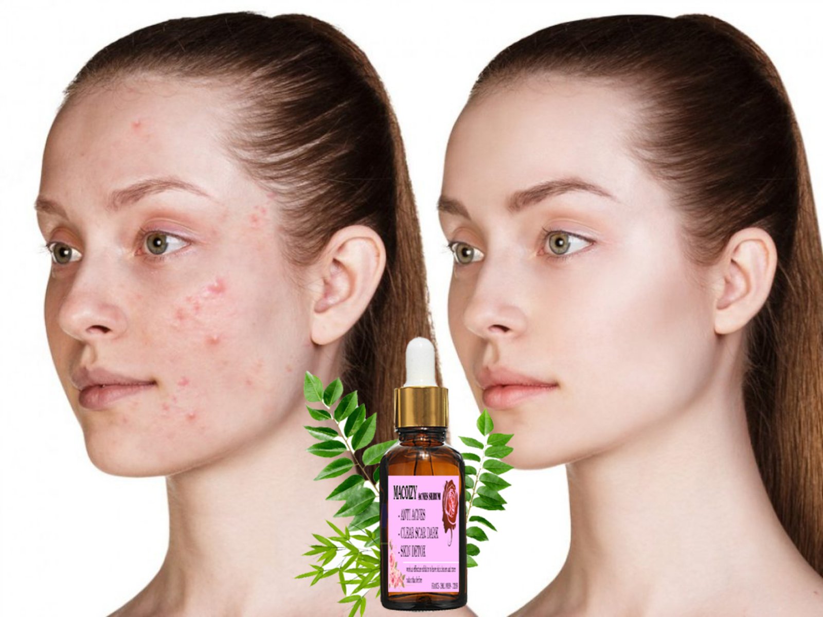 [HCM]Serum Giảm Mụn Mờ Thâm Macoizy Của Pháp