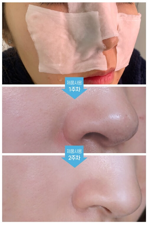 Dung Dịch Ủ Mụn MediPeel Extra Super 9
