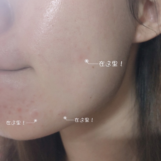 MIẾNG DÁN MỤN CAREPLUS OLIVE YOUNG