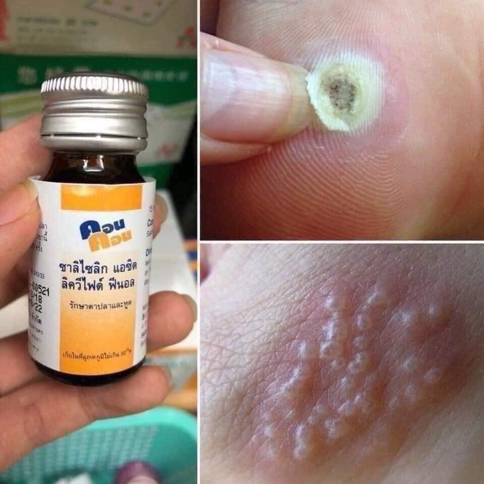 Chấm Mụn Cơm Mụn Cóc ConCon Thái Lan 15ml