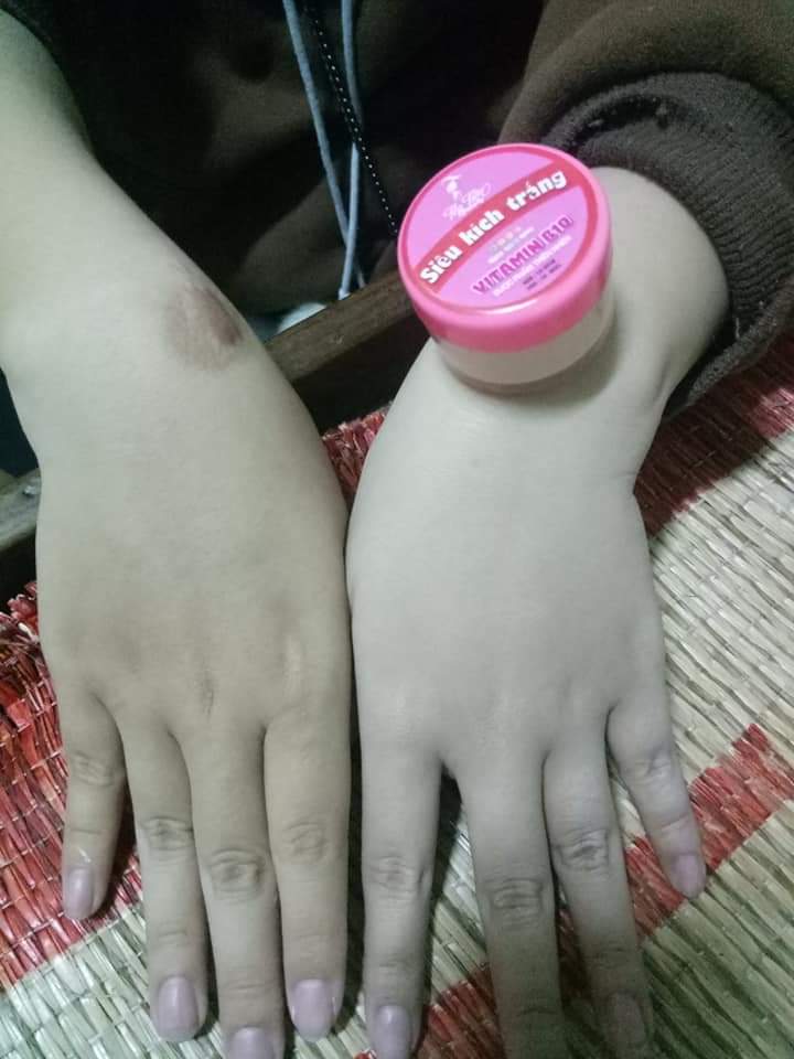 Combo 5 Hộp Kem Kích Trắng Vitamin B10 Siêu Trắng