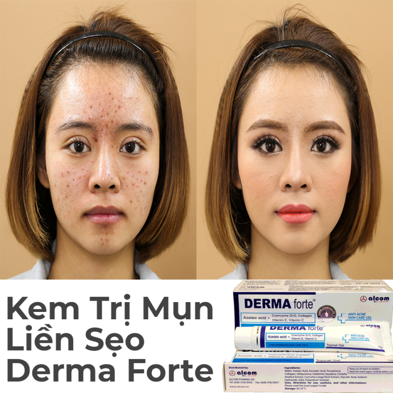 Gel Ngừa Mụn Gel Mờ Thâm Giảm Mụn Derma Forte Gel 15gr Ngừa và Loại Sạch Tất Cả Các Loại Mụn Trứng Cá, Tẩy Sạch Bã Nhờn Trên Da. Dưỡng Trắng Mịn Da Bảo Hành Uy Tín giá rẻ