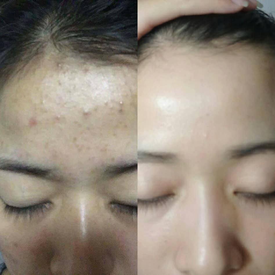 Chấm mụn siêu tốc Linh Sâm 12 lọ