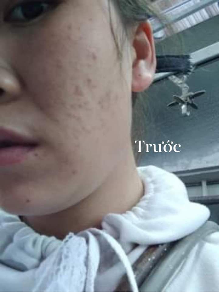 Serum Nhân Sâm Phục hồi da mỏng chỉ đỏ