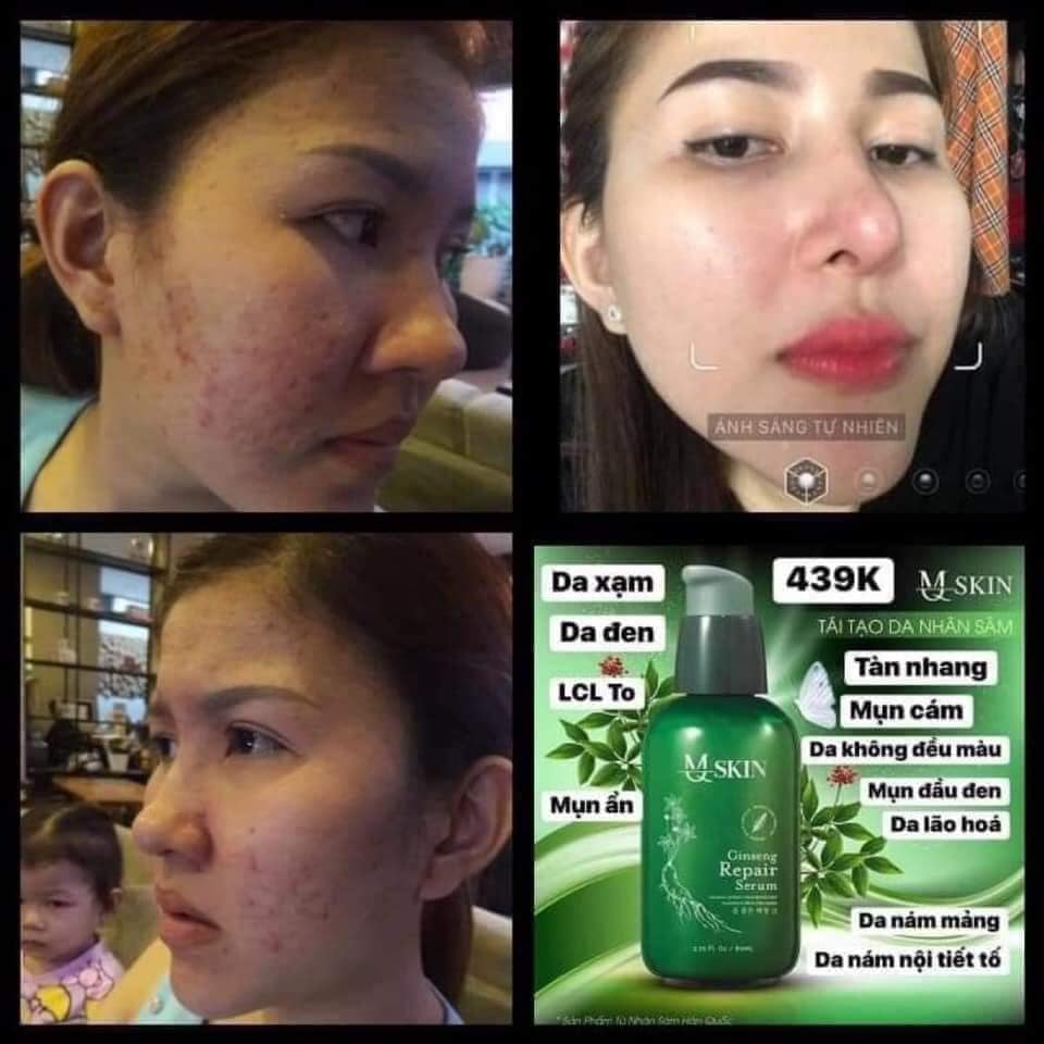 TÁI TẠO DA NHÂN SÂM MSKIN HÀN QUỐC