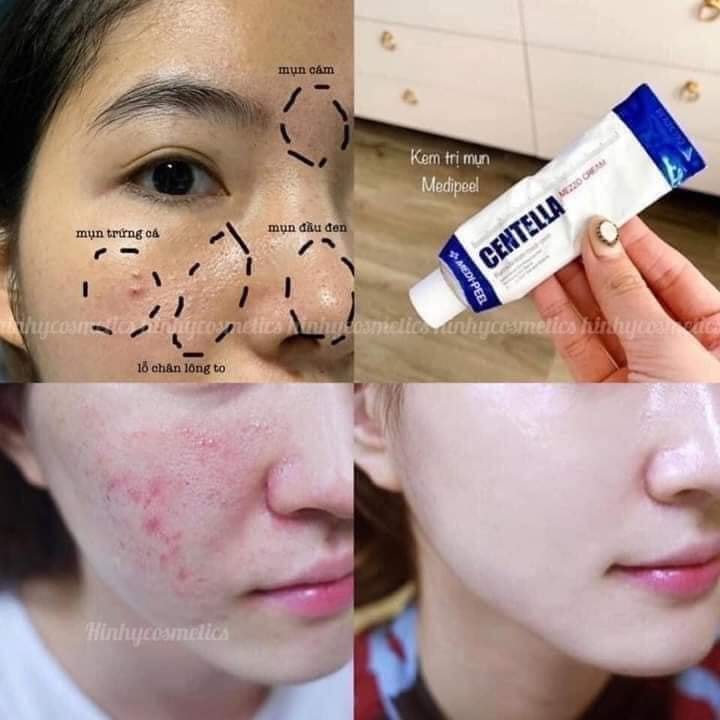 KEM TRỊ, MỤN CENTELLA MEDIPEEL