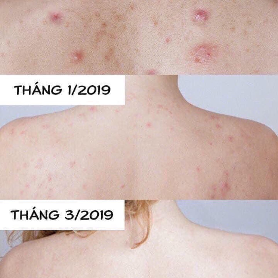 Xà phòng đen ngăn mụn lưng For Back- Happy House