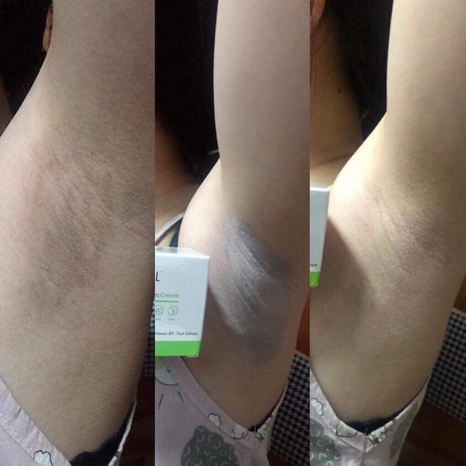 Kem trị thâm nách, thâm môi, thâm đầu gối OL-CELL
