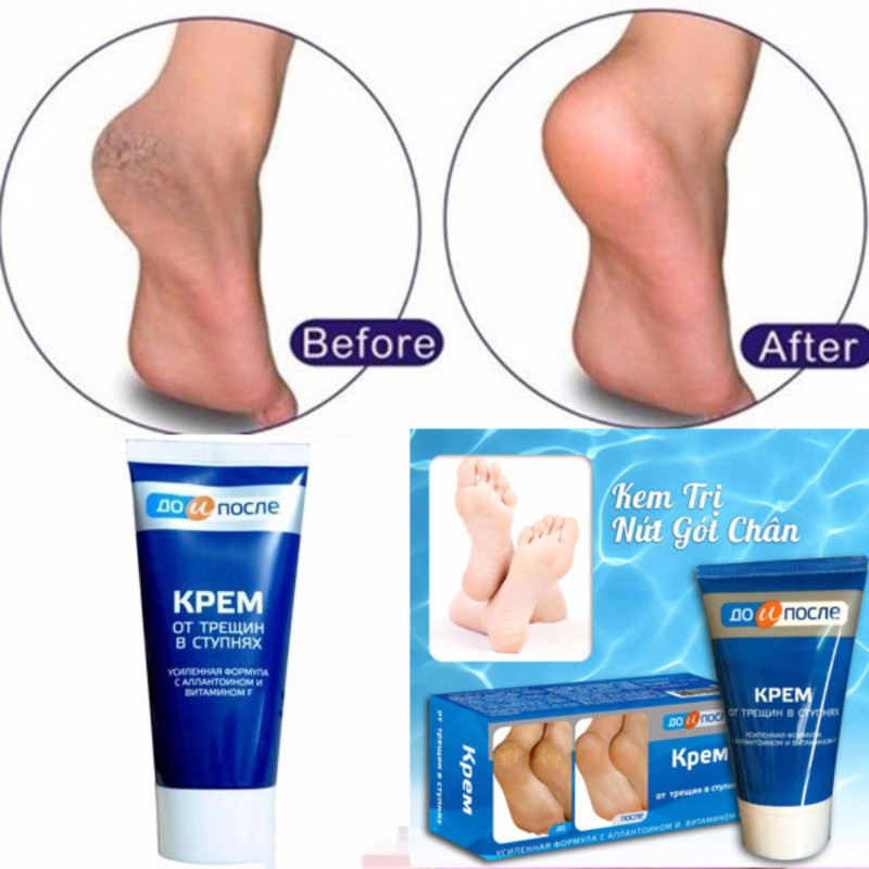 Kem nứt gót chân Kpem Nga