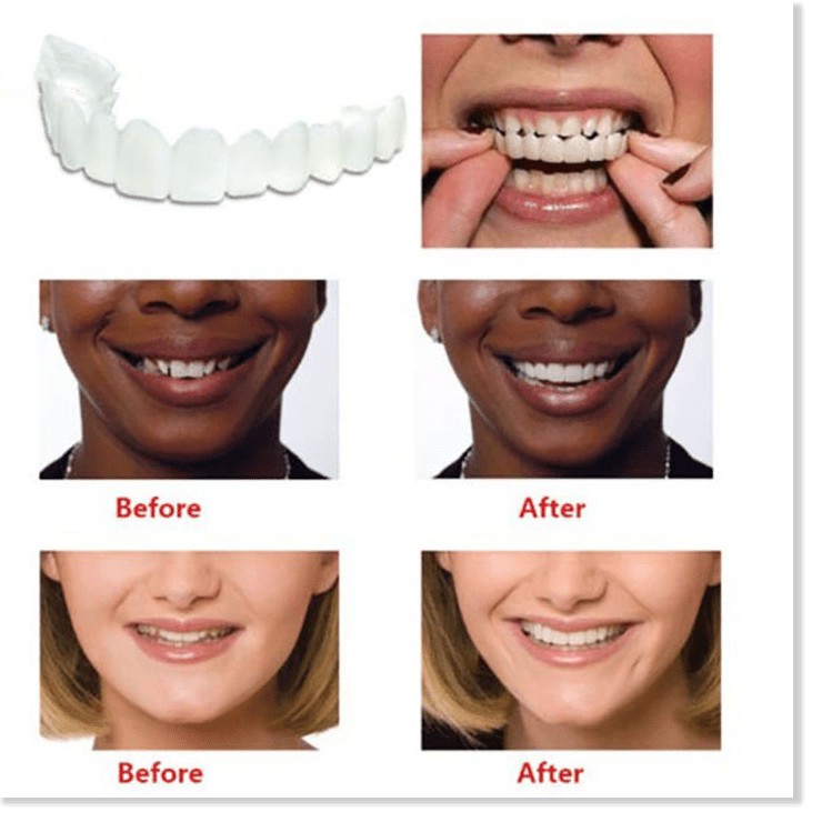 Răng Giả Snap On Smile Kmdeal