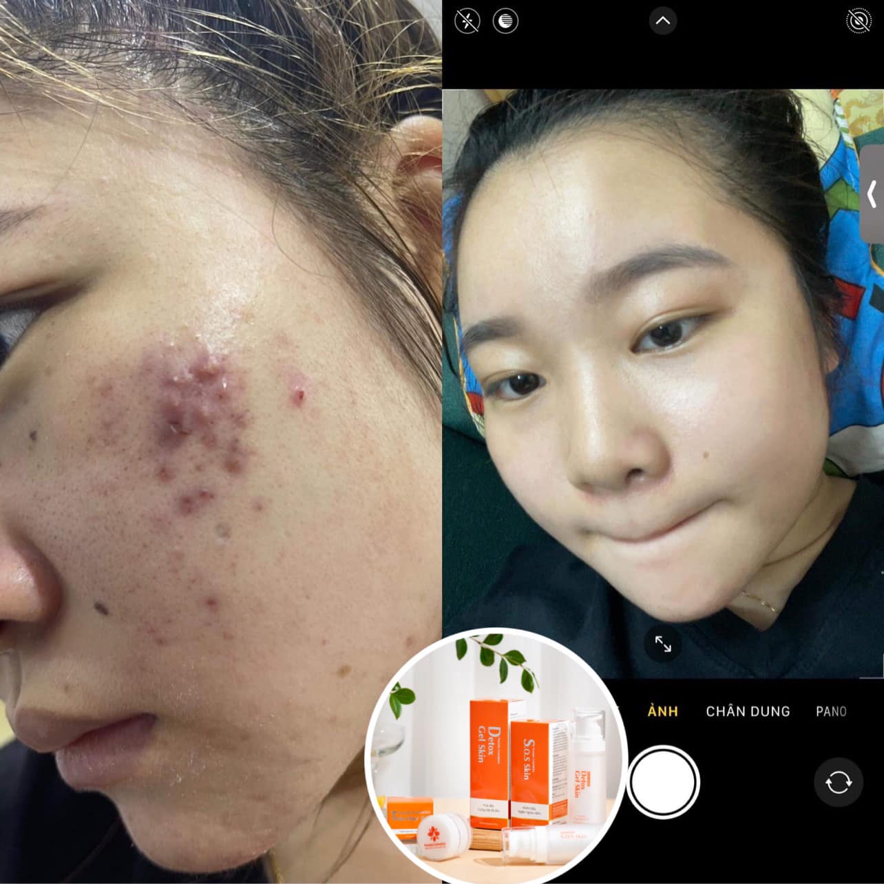 Cao Mụn Cure Medicine-Fourets