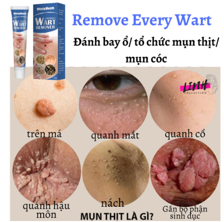 {ĐÁNH BẬT} Mụn Cóc, Mụn Thịt Remove Every Warts