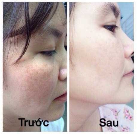 Kem Vua trị nám của Nhật Bản