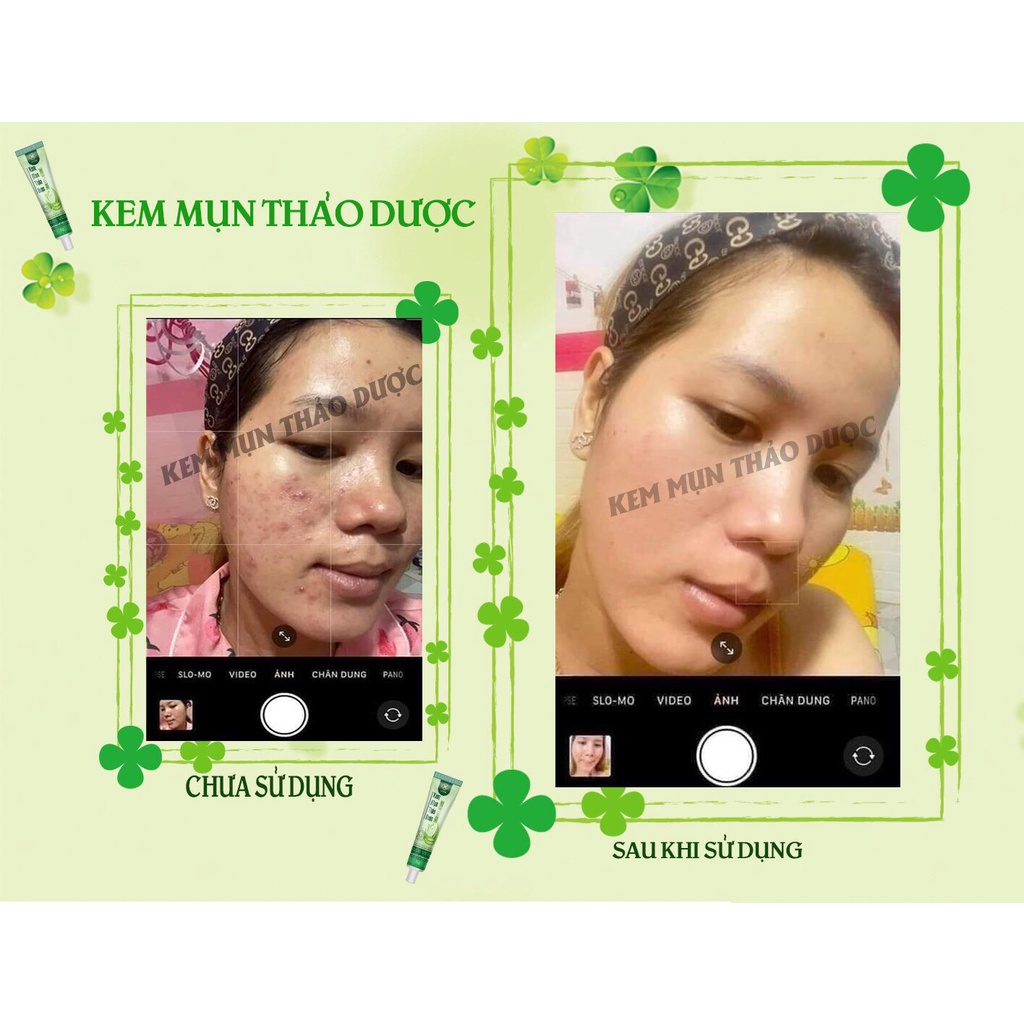 KEM TRỊ MỤN THẢO DƯỢC SINORI