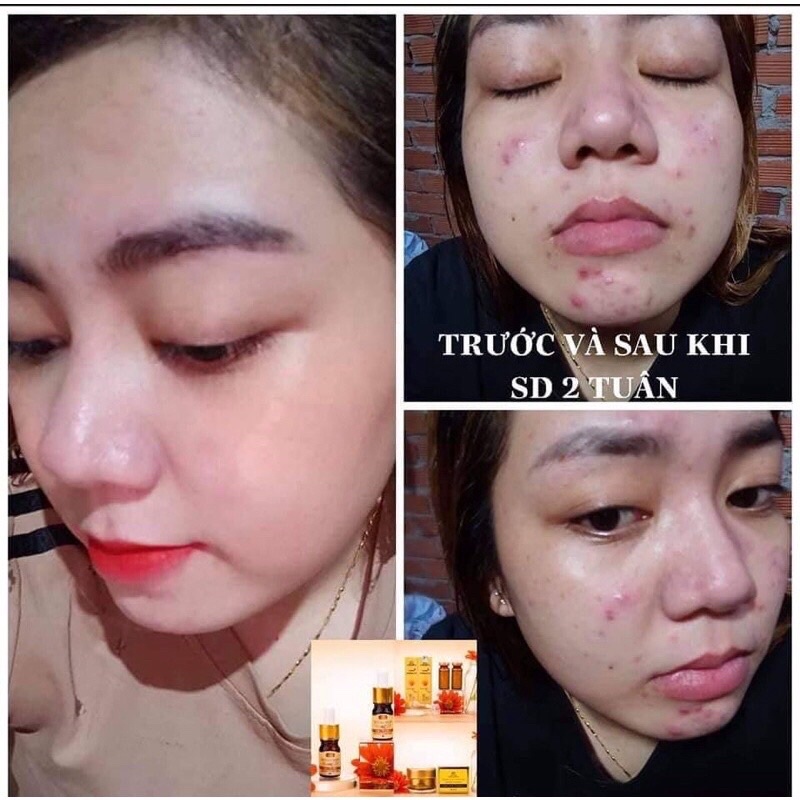 Serum Mụn Collagen X3 - Siêu Ngừa Mụn 5ML